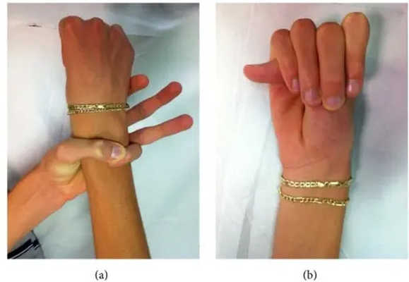 Wrist and thumb sign in Marfan syndrome.jpg copia